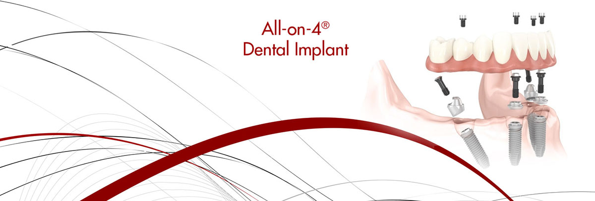 Tracy All-on-4 Dental Implants