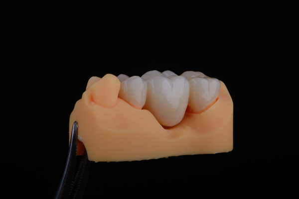 Popular Dental Bridge Solutions