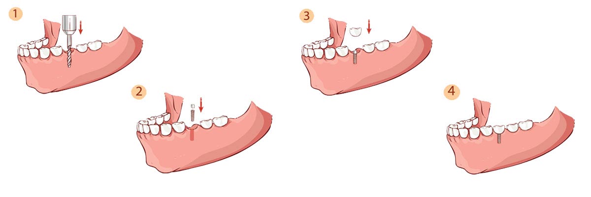 Tracy The Dental Implant Procedure