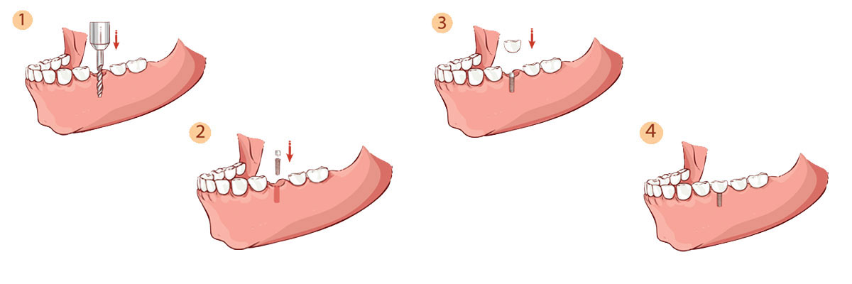Tracy Dental Implant Restoration