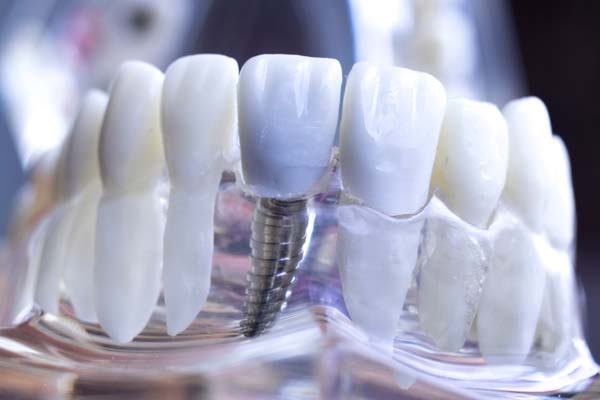 Ask A Dentist: Am I A Candidate For Dental Implants?
