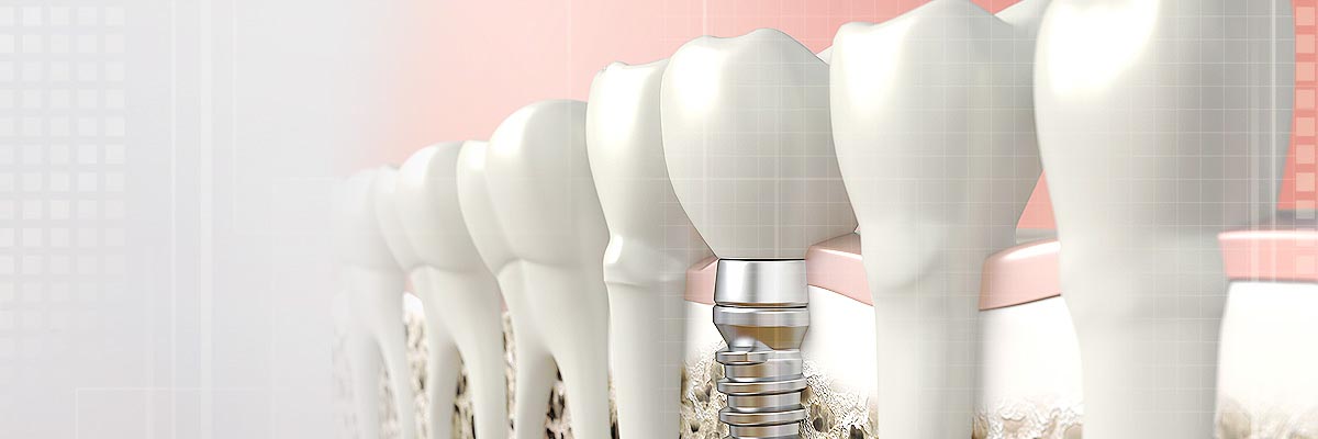 Tracy Implant Dentist