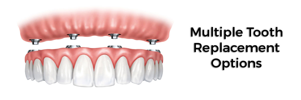 Tracy Multiple Teeth Replacement Options