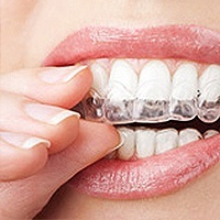 Invisalign® Dentist