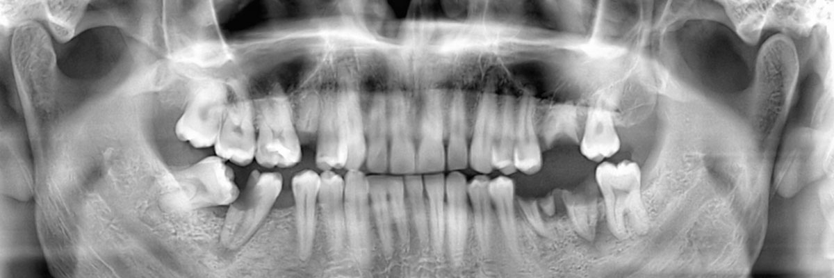 Tracy Wisdom Teeth Extraction